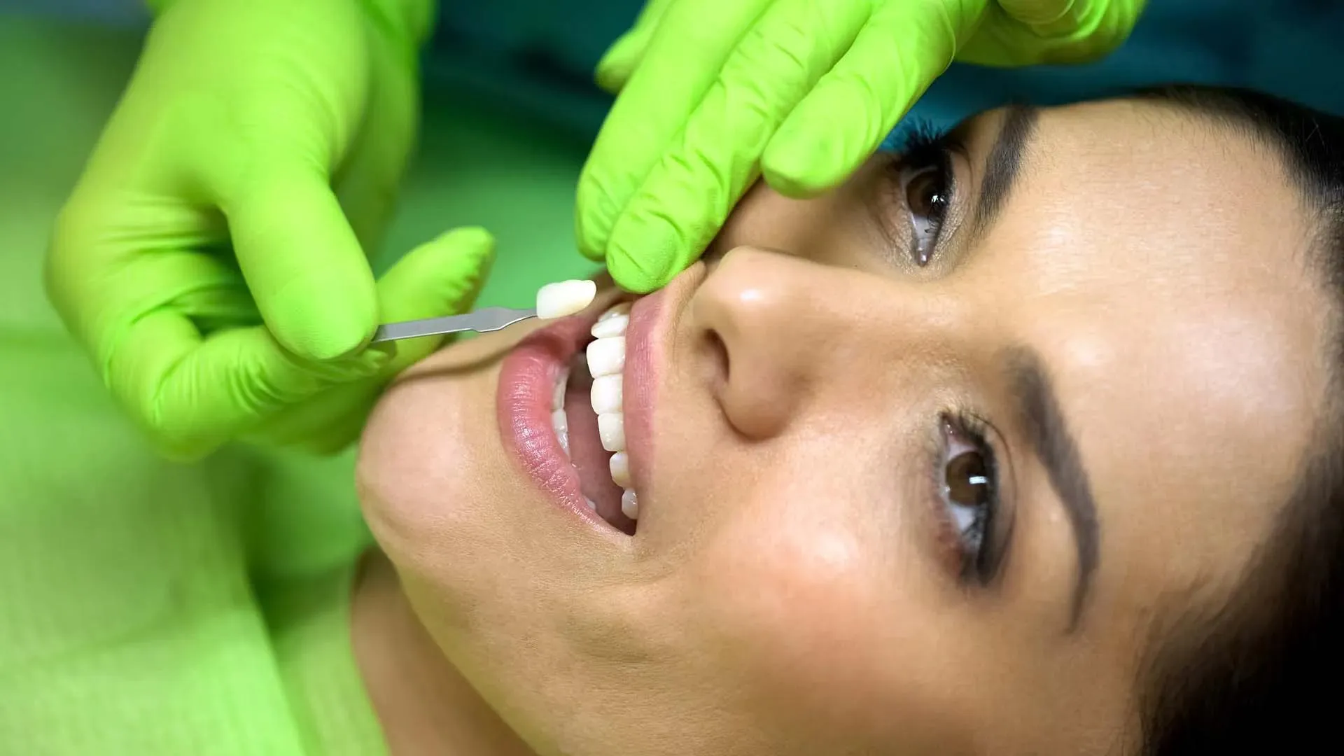 Dentist in green gloves holding a dental veneer near a patient's teeth during fitting.